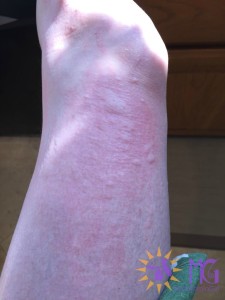leg with hives